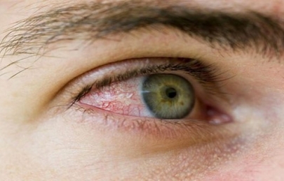 VIÊM KẾT MẠC MÙA XUÂN – NGUYÊN NHÂN, TRIỆU CHỨNG VÀ ĐIỀU TRỊ